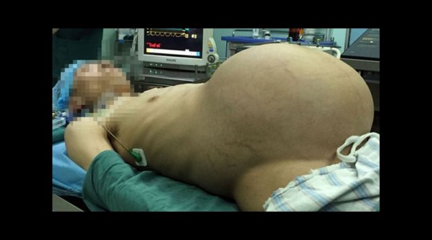 Karnından 15 kiloluk tümör çıktı
